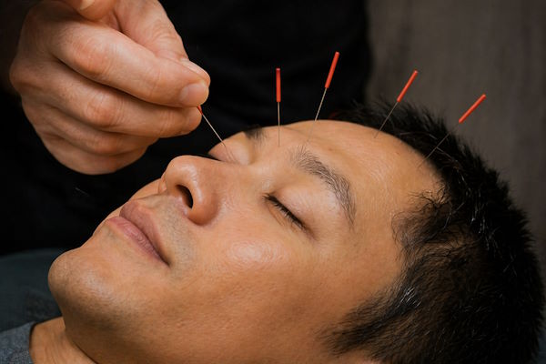 Acupuncture Brampton